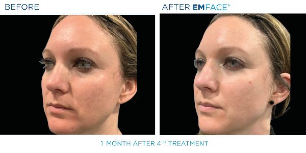 EmFace B&A1