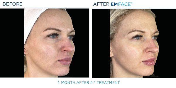 EmFace B&A3