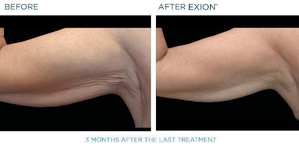 Exion B&A 1