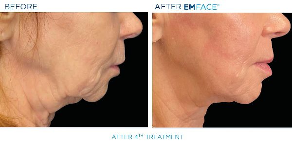 10-EmFace B&A