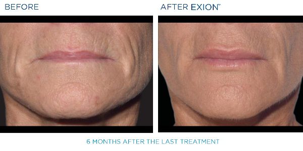 Exion B&A 10