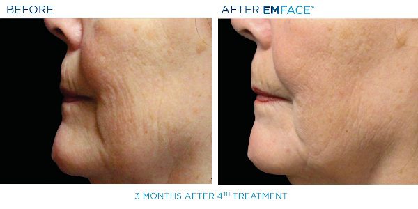 11-EmFace B&A