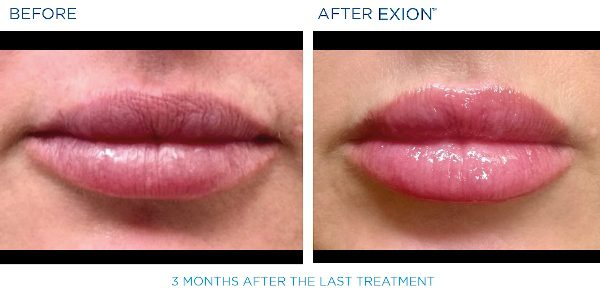 Exion B&A 9