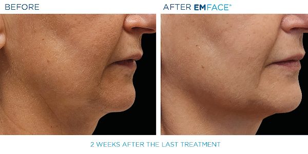 12-EmFace B&A