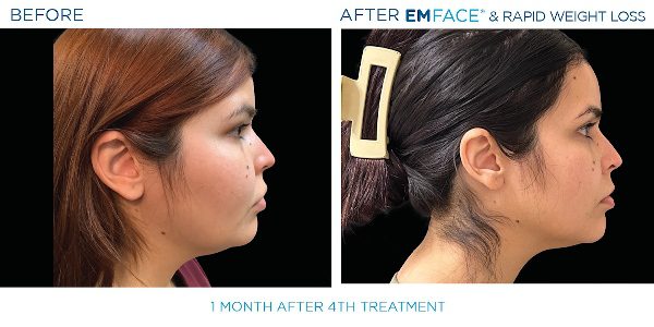 13-EmFace B&A