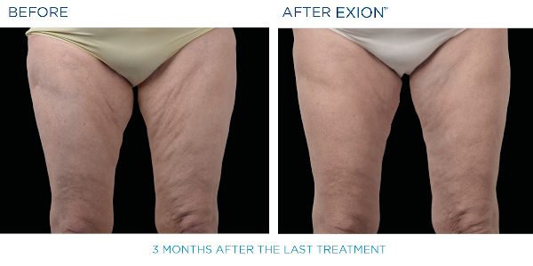 Exion B&A 12