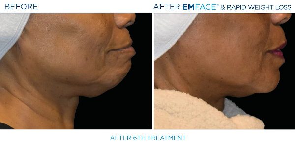 14-EmFace B&A