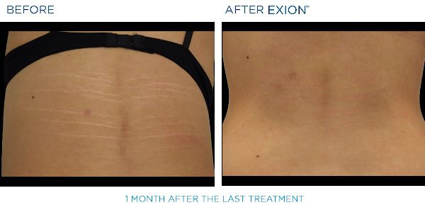 Exion B&A 2