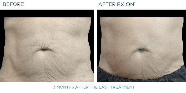 Exion B&A 3