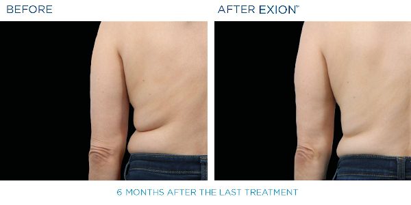 Exion B&A 4