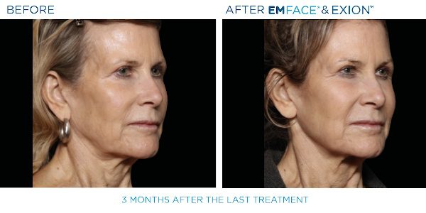 6-EmFace B&A