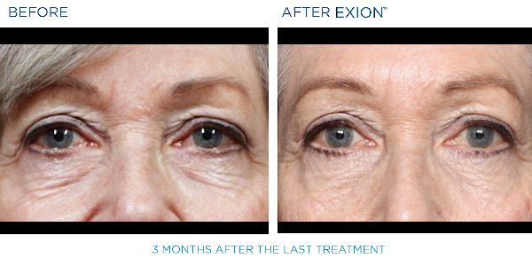 Exion B&A 6