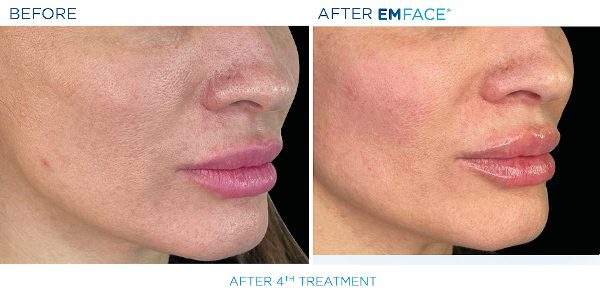 7-EmFace B&A