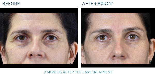 Exion B&A 7