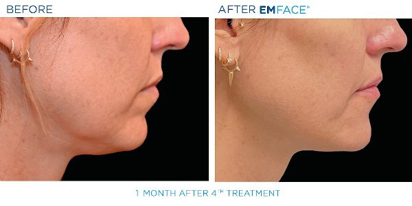 8-EmFace B&A