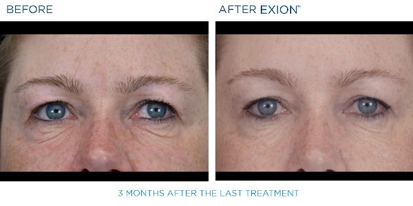 Exion B&A8