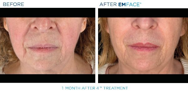 9-EmFace B&A