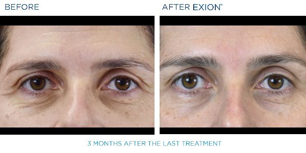 Exion B&A9