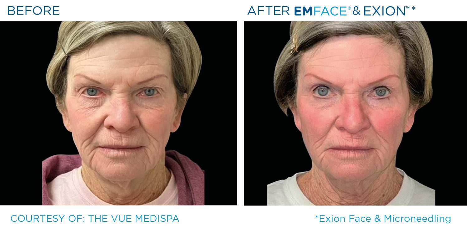 Emface Exion B&A 12