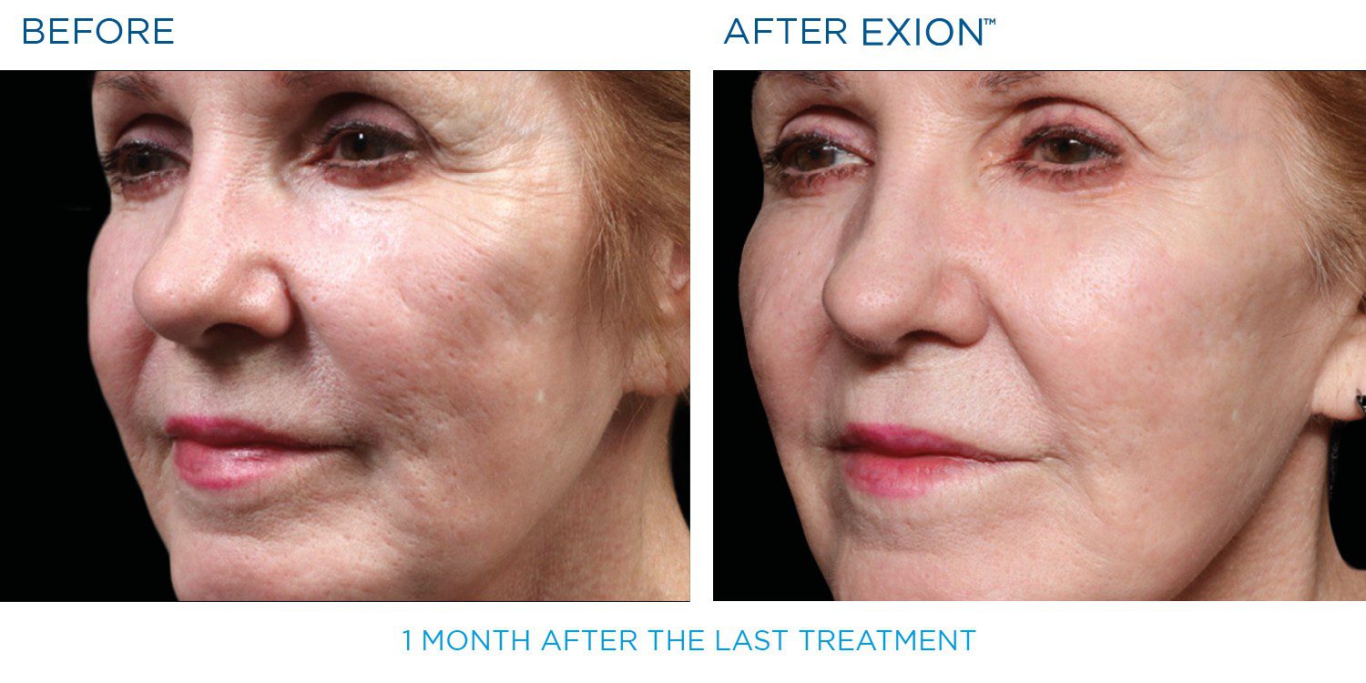 Image of before and after EXION results